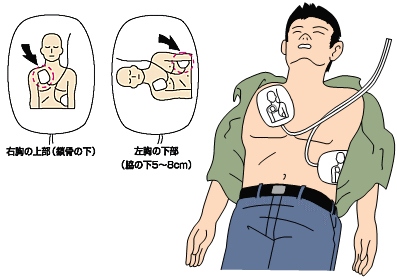 AEDのパッドを貼る位置の説明のイラスト